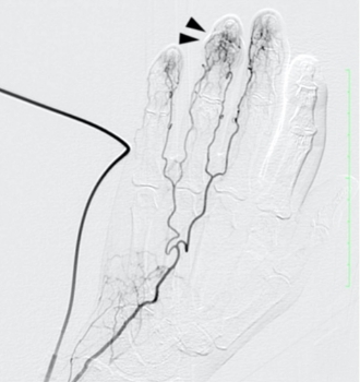 モヤモヤ血管イメージ