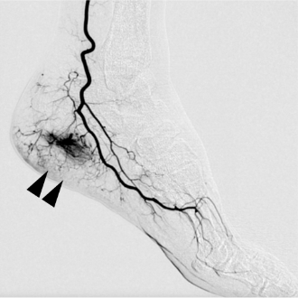 モヤモヤ血管イメージ