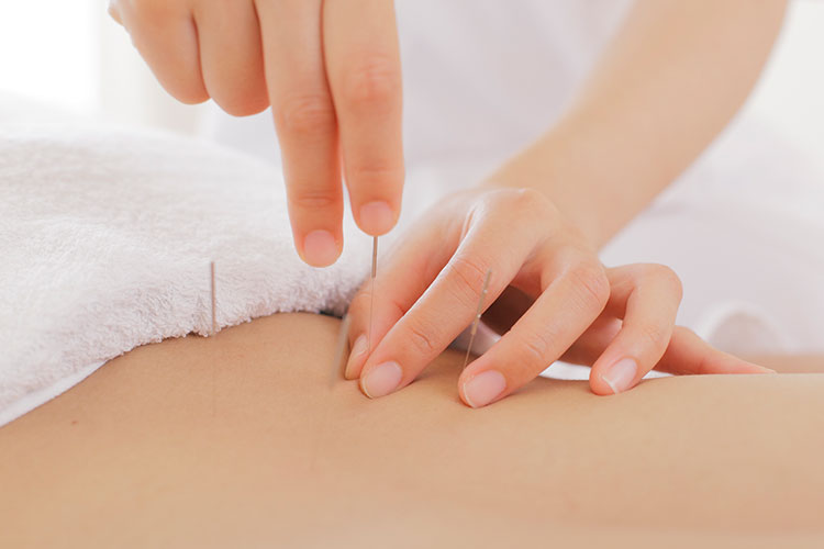 鍼灸イメージ
