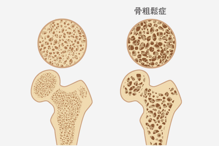 骨粗鬆症イメージ